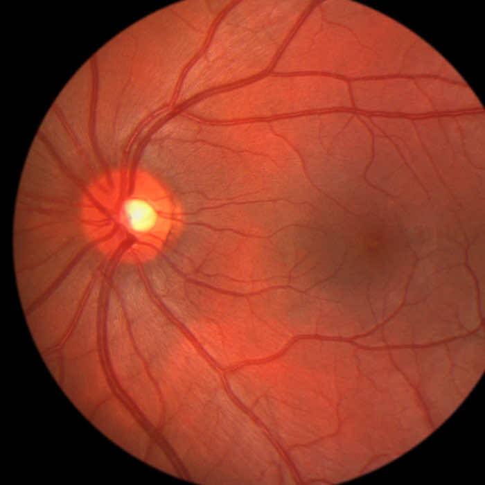 retina treatment